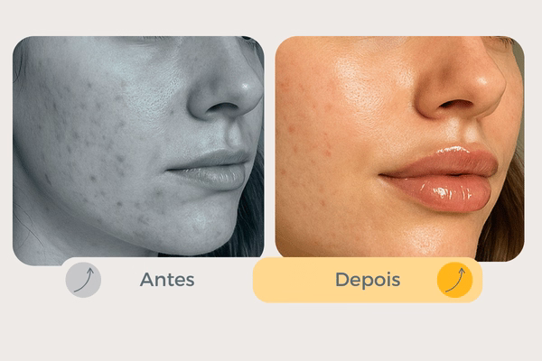  
Preenchimento Labial natural com Ácido Hialurônico Dra Carmen Estética Clube
