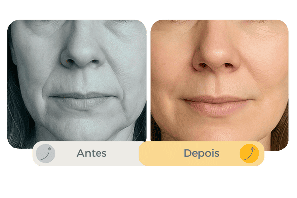 Tratamento para bigode chinês e linhas de marionete em Curitiba Estética Clube